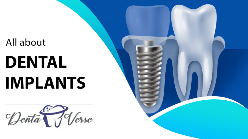 Dental Implant Logo Vector Images (over 7,500)