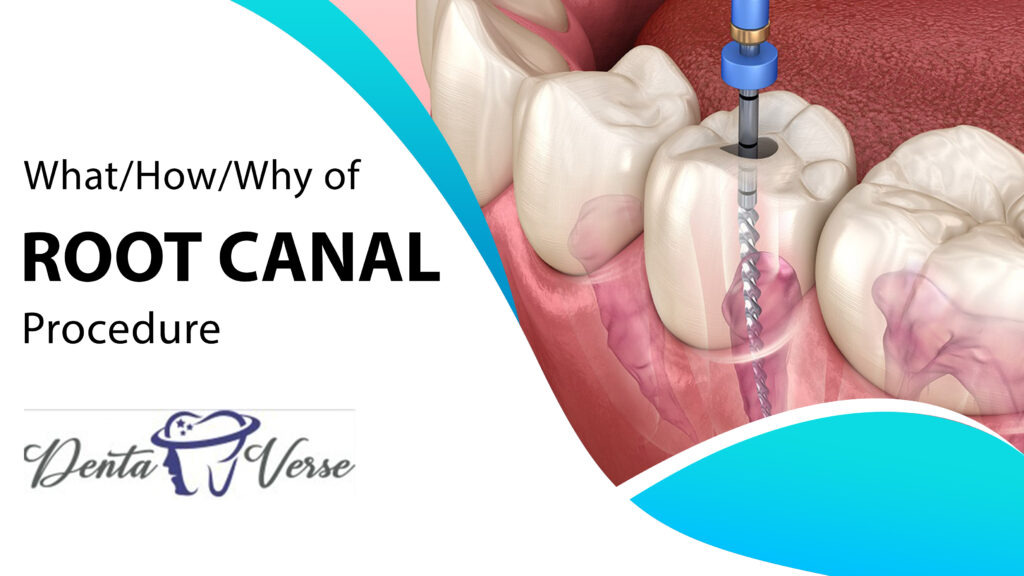 What/How/Why of Root Canal Procedure