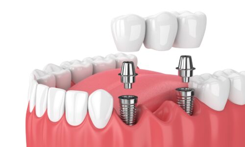 A long term solution for missing teeth- Dental implants