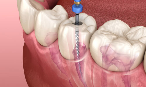 Root canal Treatment