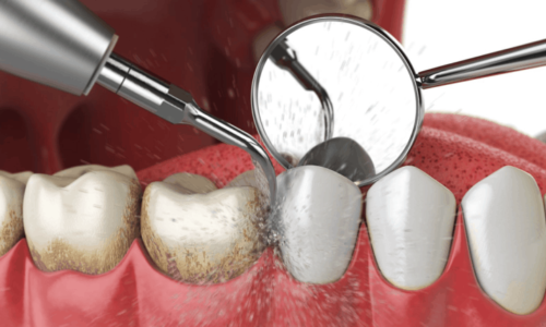 Side effects of teeth cleaning