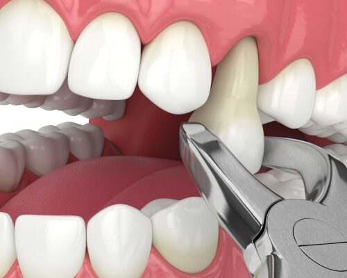 DENTAVERSE DENTAL CLINIC Best Dental Clinic in Hadapsar, Pune, Dentist in Kharadi