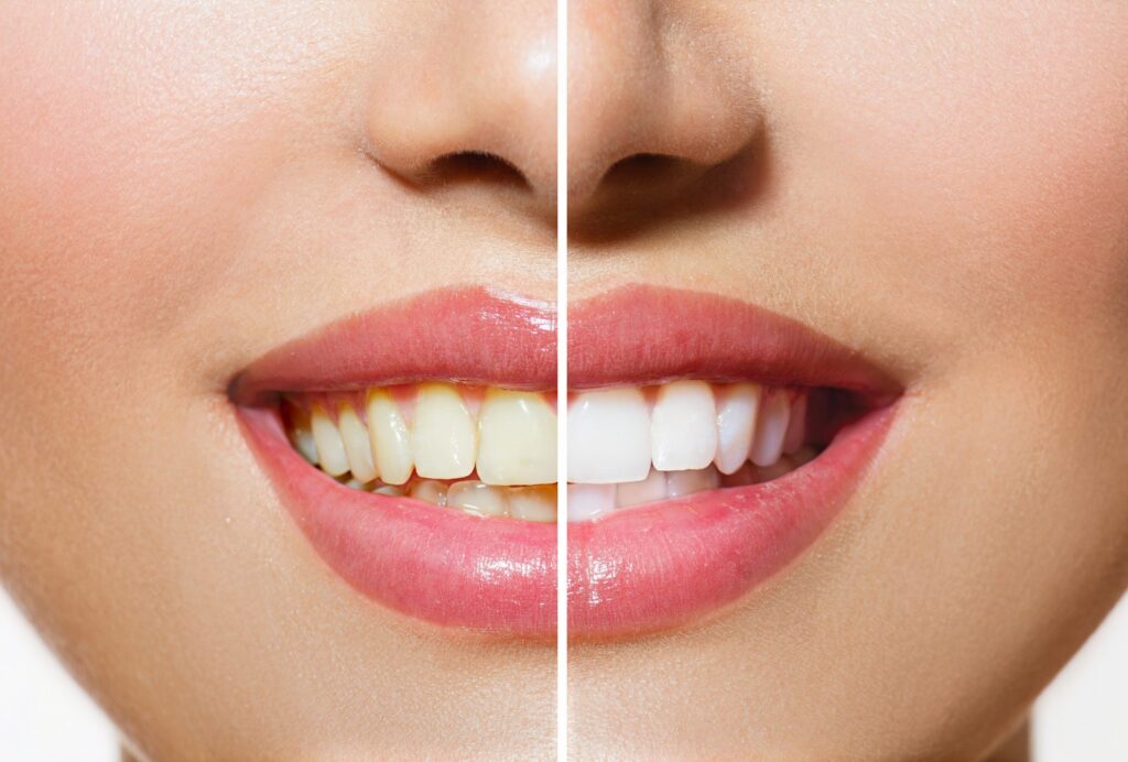 professional teeth whitening at Dentaverse Dental Care