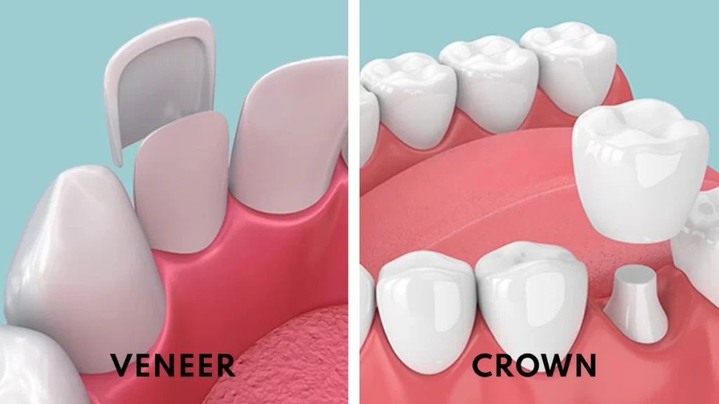 Veneers and Laminates: Choosing the Right Smile Solution for You