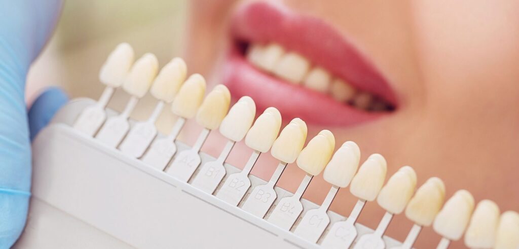 Brighten your smile with our professional tooth whitening services