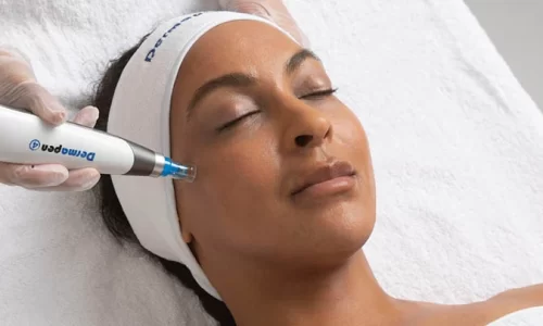 Microneedling treatments at Dentaverse Dental Care