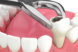 Safe and gentle teeth extraction services at Dentaverse Dental Care