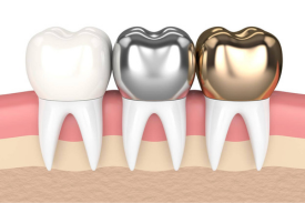 Dental Crown