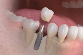 Dental implants