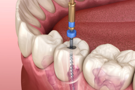 root canals