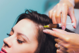 How PRP Treatment Affects Hair Loss: Before and After 3 Months