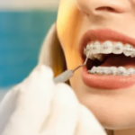 Everything You Need to Know About Adult Braces: Age Considerations, Benefits and Drawbacks, and Before & After Comparisons