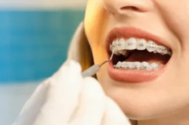 Everything You Need to Know About Adult Braces: Age Considerations, Benefits and Drawbacks, and Before & After Comparisons