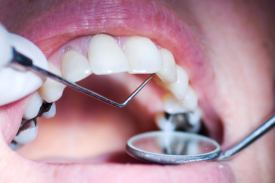 Dental cavities, also known as tooth decay